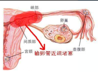 输卵管堵塞了，我是不是要做试管婴儿？