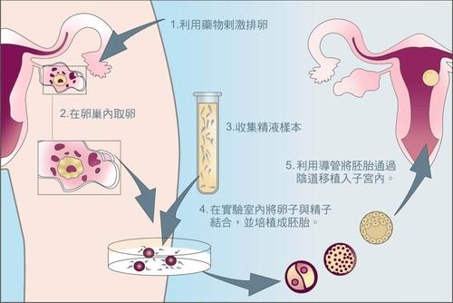 重庆高龄借卵机构-如何检测男性的精子浊度？